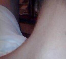 頸部激光脫毛后果圖