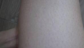 大腿處3次激光脫毛果