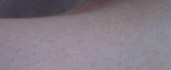 膝蓋彎激光脫毛后果圖