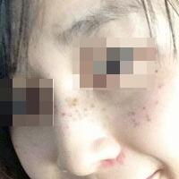 花費4000元做了激光祛斑，終于把雀斑消滅了555555