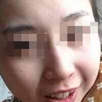 花費4000元做了激光祛斑，終于把雀斑消滅了555555