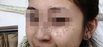 花費(fèi)4000元做了激光祛斑，終于把雀斑消滅了