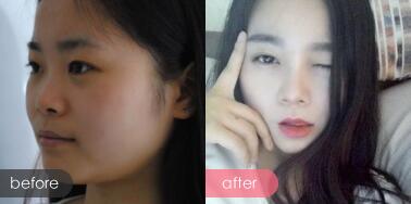 隆鼻前后的對(duì)比照片