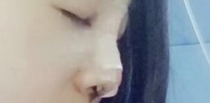 將自己隆鼻恢復(fù)過程分享給大家，希望對(duì)有需求的MM有幫助