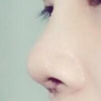 將自己隆鼻恢復過程分享給大家，希望對有需求的MM有幫助