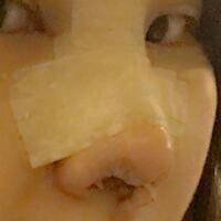 假體隆鼻，耳軟骨墊鼻尖，鼻頭縮小等隆鼻整形分享