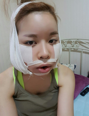 v－line手術(shù)后變小臉美眉 伊美爾孫麗君做的