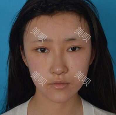 在成都天使之翼自體脂肪面部填充大家看看果怎么樣