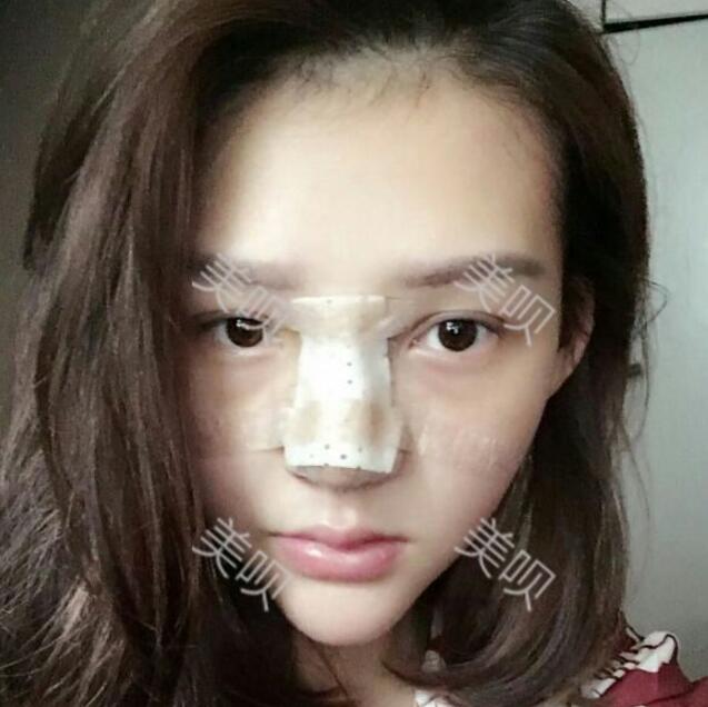 重慶聯(lián)合麗格做的硅膠假體隆鼻自我感覺(jué)很漂亮哦