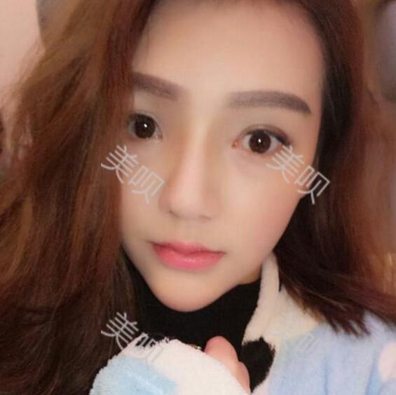 重慶聯(lián)合麗格做的硅膠假體隆鼻自我感覺(jué)很漂亮哦