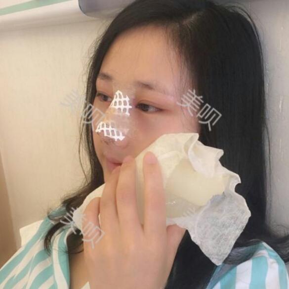 把自己的自體脂肪隆鼻過(guò)程分享給大家我是真的變美了