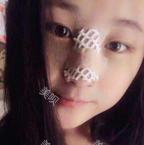 把自己的自體脂肪隆鼻過(guò)程分享給大家我是真的變美了