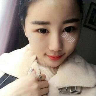 給大家分享下我的自體脂肪面部填充過程希望對(duì)大家有幫助