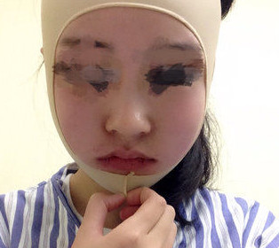 磨骨瘦臉后，終于擺脫大餅?zāi)樍耍? /> </a>
										<a href=