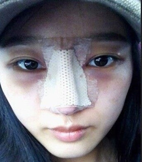 假體隆鼻手術(shù)過程前后對(duì)比圖片