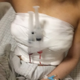 去年10月做的假體隆胸手術(shù)，大家來(lái)看看怎么樣