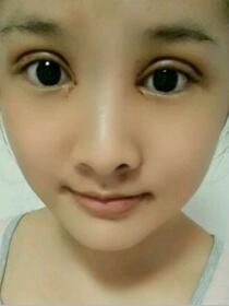 去年12月初在南京韓辰做的雙眼皮，大家來(lái)看看果怎么樣?