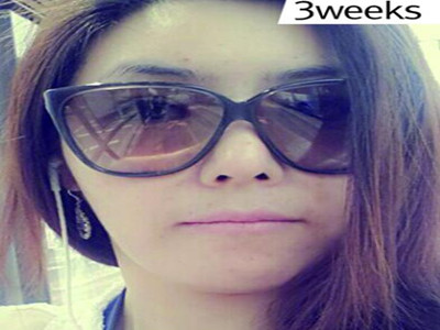 電波l皮除皺讓我彈走小皺紋 果真的很不錯