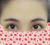 一次性做了全切雙眼皮和開內(nèi)眼角兩項(xiàng)整形，佩服自己的勇氣