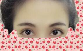 割雙眼皮開眼角術(shù)后果圖分享