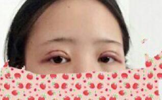 全切雙眼皮和開內(nèi)眼角兩項整形，費用3880元