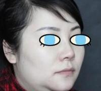 假體隆鼻兩個(gè)月了，果挺滿意的