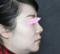 假體隆鼻兩個(gè)月了，果挺滿意的