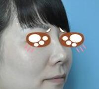 假體隆鼻兩個(gè)月了，果挺滿意的