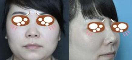 假體隆鼻手術(shù)前后對比圖