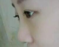 同學(xué)做了隆鼻，我也去做了個(gè)假體隆鼻，臉型真心立體了好多