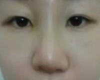 同學(xué)做了隆鼻，我也去做了個(gè)假體隆鼻，臉型真心立體了好多