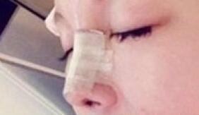 假體隆鼻的照片,假體隆鼻過程介紹