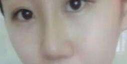 假體隆鼻恢復(fù)圖