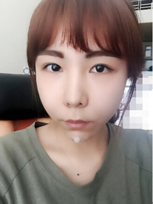 玻尿酸去除法令紋后人生明朗了 軍美王世虎做的