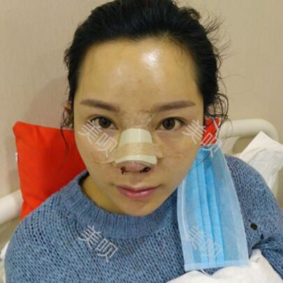 我做的自體脂肪隆鼻果杠杠的我很滿意~~~