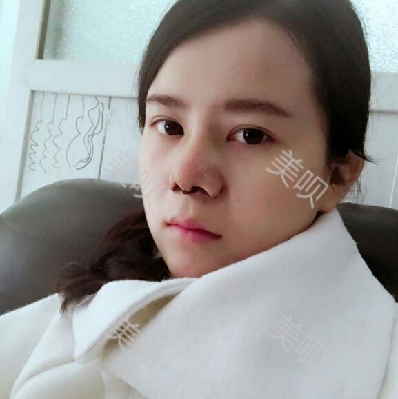 玻尿酸隆鼻后讓我告別了塌鼻梁為大家分享隆鼻心得