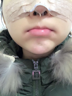 去年做的隆鼻整形手術(shù)，恢復(fù)的差不多了