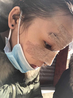 去年做的隆鼻整形手術(shù)，恢復(fù)的差不多了