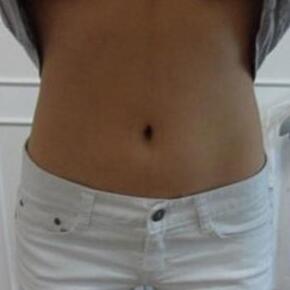 北京常好麗格腰腹吸脂后20天的感受 恢復(fù)日記來(lái)咯~