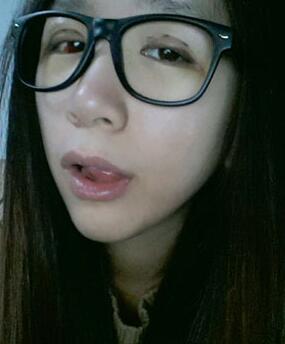 北京常好麗格三點定位雙眼皮恢復一個月經(jīng)歷