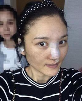 北京常好麗格做假體隆鼻3個月