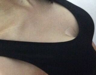 合肥華美趙輯做的曼托假體隆胸后我從A變成C罩杯