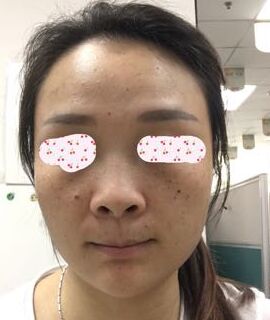 激光去黃褐斑后皮膚干凈多了呢