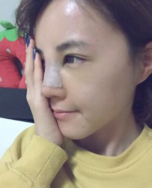 硅膠假體隆鼻后側(cè)面看起來超**的