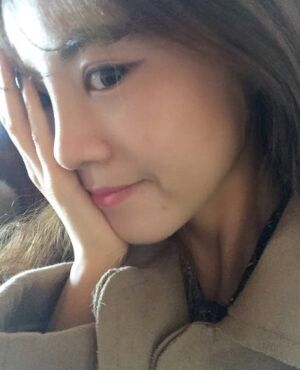 硅膠假體隆鼻后側(cè)面看起來超**的