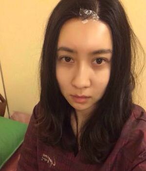 自體脂肪全臉填充后整個(gè)面部都很飽滿喲