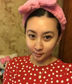 自體脂肪全臉填充后整個(gè)面部都很飽滿喲