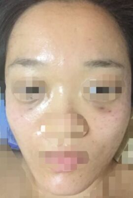 打了水光補(bǔ)水皮膚嫩滑有光澤了