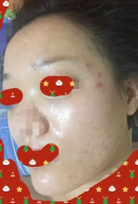 打了水光補(bǔ)水皮膚嫩滑有光澤了