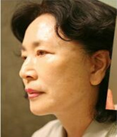 拉皮除皺手術(shù)讓我年輕20歲